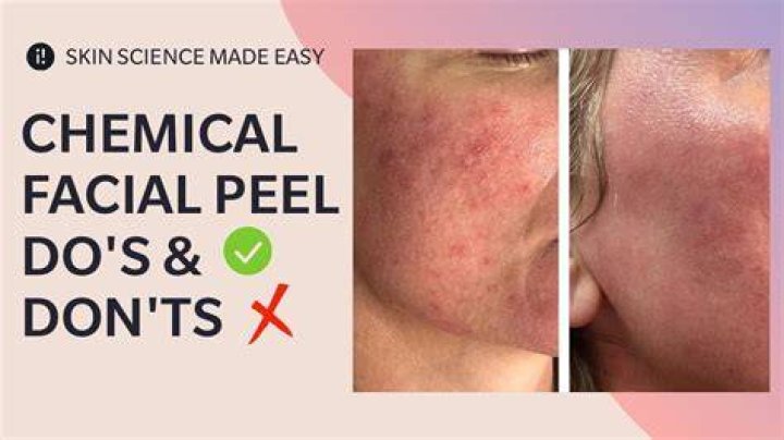 are chemical peels safe