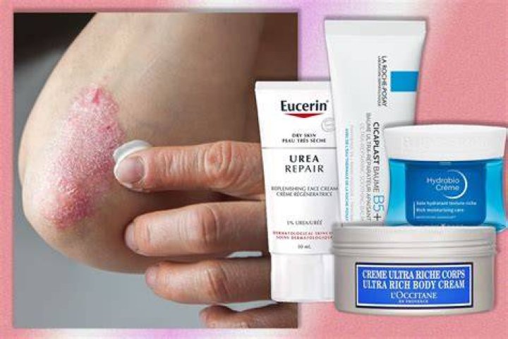 best cream for psoriasis