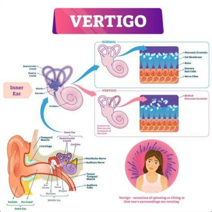 Causes of Vertigo