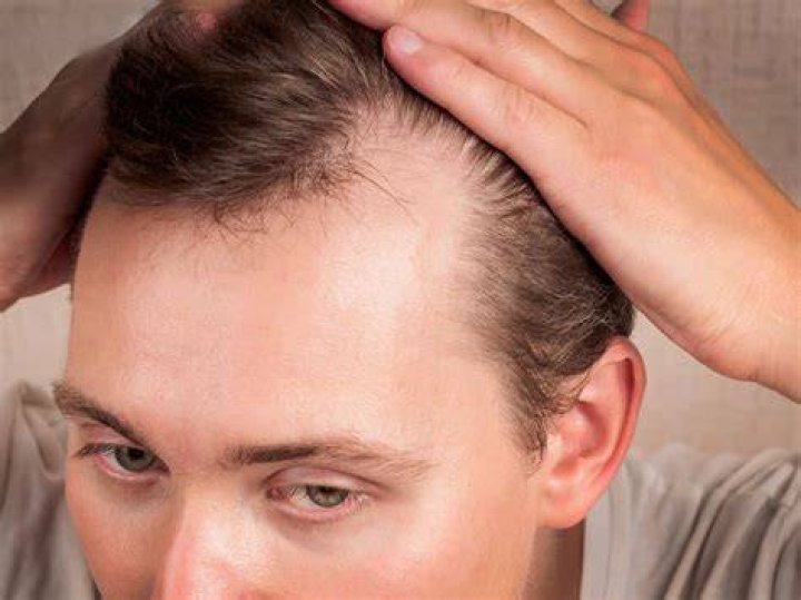 is my hairline receding