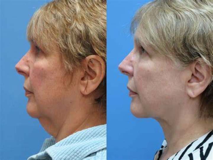 saggy neck