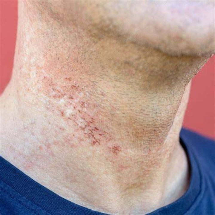 shaving rash
