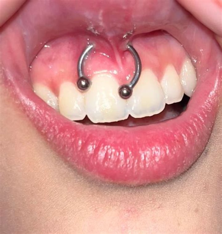 What is smiley piercing?